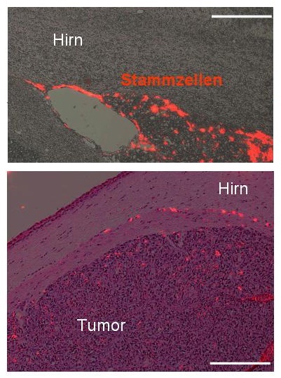 Injizierte Stammzellen, die den Tumor stellen, ihn umgeben und in ihn einwandern