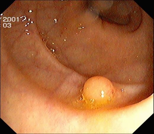 Ein Darmpolyp