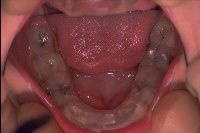 Eine Okklusionsschiene auf der unteren Zahnreihe