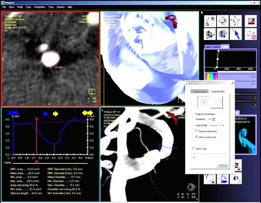 Mit der 3D-Angiographie stehen verschiedene detaillierte Informationen zur Verfügung. Links oben wird die Engstelle angesteuert, die die Durchblutung behindert. Die Kurve darunter zeigt den Verlauf des Gefäßdurchmessers. Unten rechts ist ein größerer