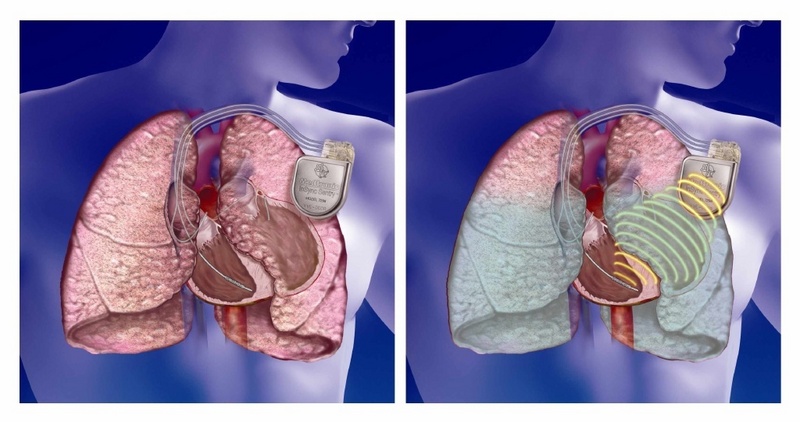 Wirkprinzip der Messung der Flüssigkeitsansammlung - Grafik: Fa. Medtronic Inc.