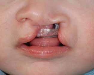 Vier Monate alter Säugling mit einseitiger Lippen-Kiefer-Gaumen-Spalte. Das Kind wurde an der Würzburger Uniklinik mit einer so genannten Platte versorgt, welche die Kiefer-Gaumenspalte abdeckt und der Wachstumssteuerung des Kiefers dient.
