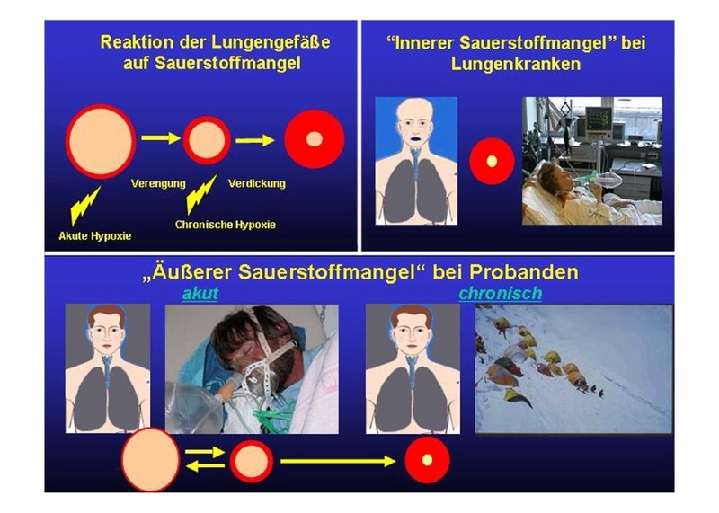 Schematische Darstellung zur Entwicklung des Lungenhochdrucks bei Lungenkranken und unter Sauerstoffmangel Bedigungen am Mount Everest