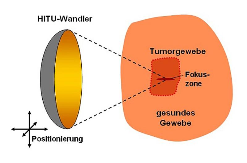 Tumortherapie mit Hilfe des „High Intensity Therapeutic Ultrasound“ (HITU) Der HITU-Wandler erzeugt den hochintensiven Ultraschall und fokussiert ihn auf das Tumorgewebe. In der Fokuszone werden die Krebszellen mit bis zu 20 000 Watt pro Quadratzentimeter abgetötet. Gesundes Gewebe, das in der unmittelbaren Nähe des Tumors liegt, bleibt unverletzt.