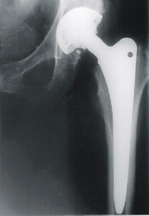 Röntgenaufnahme einer implantierten Hüftgelenksprothese