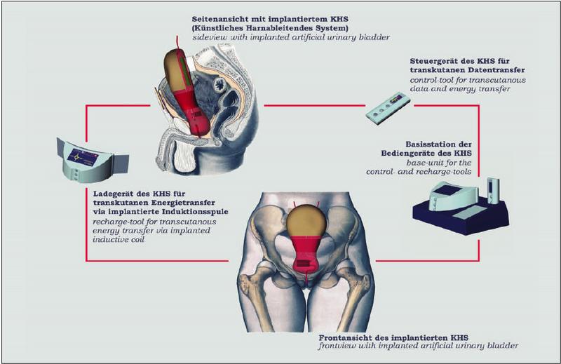 Funktionselemente der künstlichen Ersatzblase