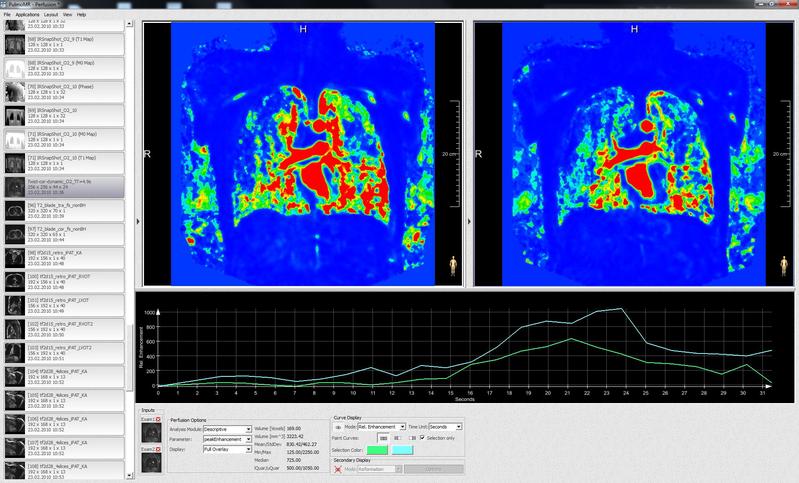 Software gestützte Analyse der Durchblutung der Lunge mit PulmoMR