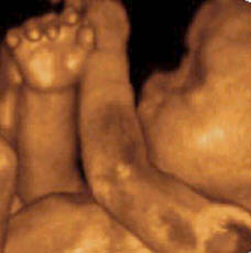 4D-Sonographie eines Kindes im Mutterleib