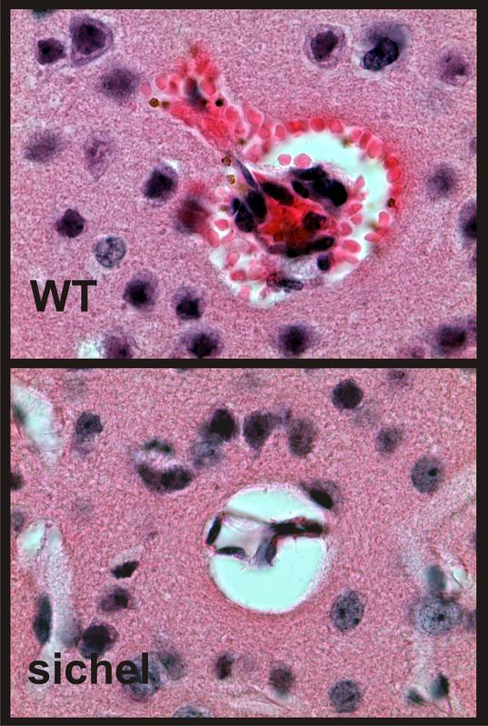 chädigung der Blut-Hirn-Schranke bei Malaria. Sichtbar sind Erythrozyten, die durch geschädigte Gefäßwände gedrückt wurden. Das bei ihrem Abbau entstehende Eisen sieht man als braune Pünktchen in Fresszellen.