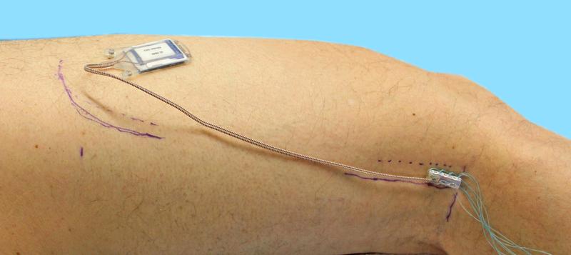 Anordnung des Implantats