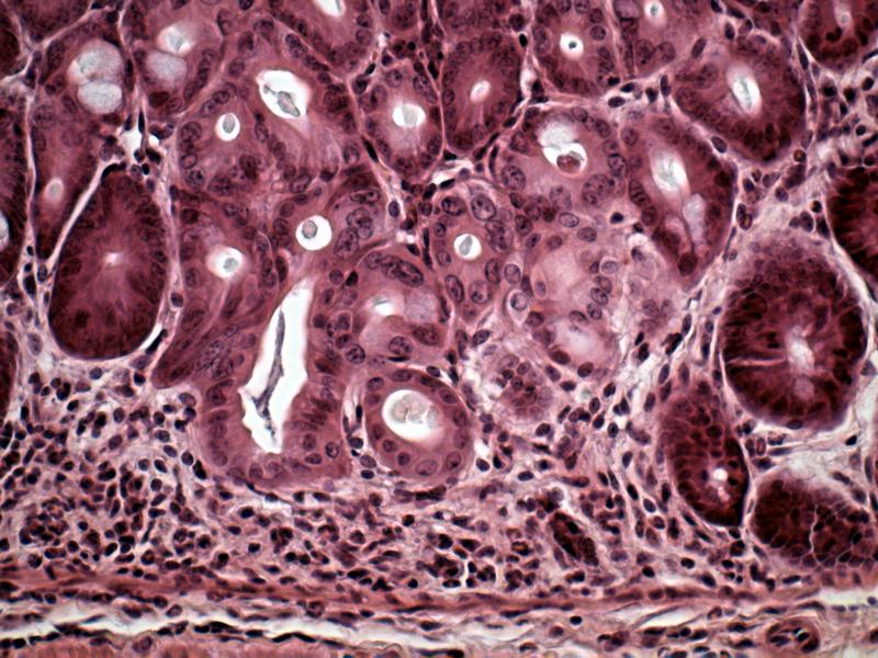 Blick durch das Mikroskop: Querschnitt durch das Gewebe eines Mäusedarms. Die deutlich erhöhte Anzahl der Immunzellen zeigt eine Erkrankung an. Die Symptome ähneln den chronisch entzündlichen Darmerkrankungen beim Menschen, zu denen Morbus Crohn gehört.