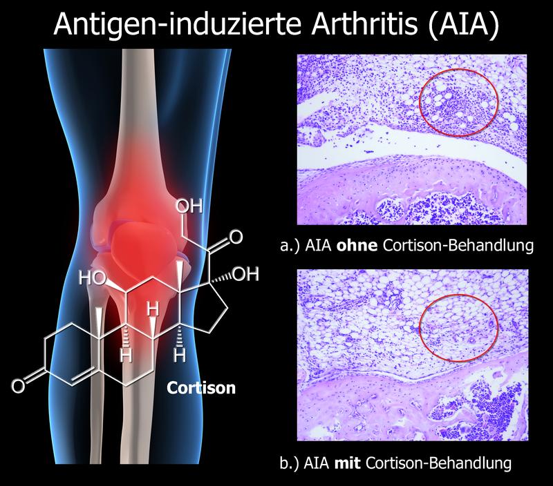 Cortison, ein Steroidhormon der Nebennierenrinde, wird seit Jahren zur Behandlung von Rheumatoider Arthritis, einer chronischen Gelenkentzündung, eingesetzt. Im Vergleich zu unbehandelter Arthritis (Abb. a) nehmen die entzündeten, lila eingefärbten Bereiche bei Cortison-Therapie (Abb. b) deutlich ab.