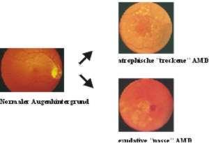 Krankheitsbilder der altersabhängigen Makuladegeneration (AMD): Deren Spätmanifestationen können sich als so genannte atrophische, "trockene" oder als exsudative, "nasse" AMD ausprägen. Bilder: Weber