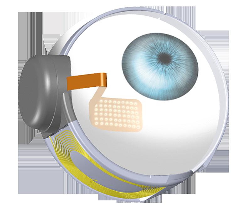 Das Argus II-System funktioniert, indem es Videobilder, die durch eine Miniaturkamera in der Brille des Patienten erfasst werden, in elektrische Impulse konvertiert. Diese werden drahtlos an die Elektroden auf der Oberfläche der Netzhaut (epiretinal) übermittelt. Die Nervenzellen (Ganglienzellen) der Netzhaut werden stimuliert, wodurch Lichtmuster wahrgenommen werden. Patienten lernen, diese Lichtmuster zu interpretieren.