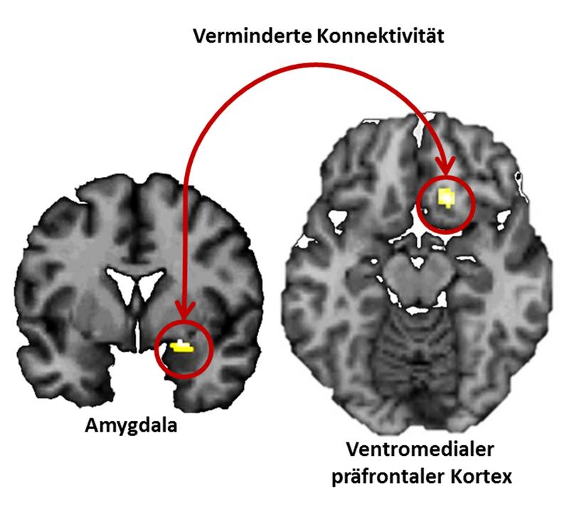 Neuronale Mechanismen der Einprägung negativer Erfahrungen: Passend zu tierexperimentellen Daten mit Knock-Out Mäusen zeigen gesunde Versuchspersonen mit natürlich vorkommenden Varianten des Dynorphin-Gens eine vermehrte Aktivität in der Amygdala während des Vergessens sowie eine verminderte Kopplung zwischen Amygdala und ventromedialem präfrontalen Kortex. 