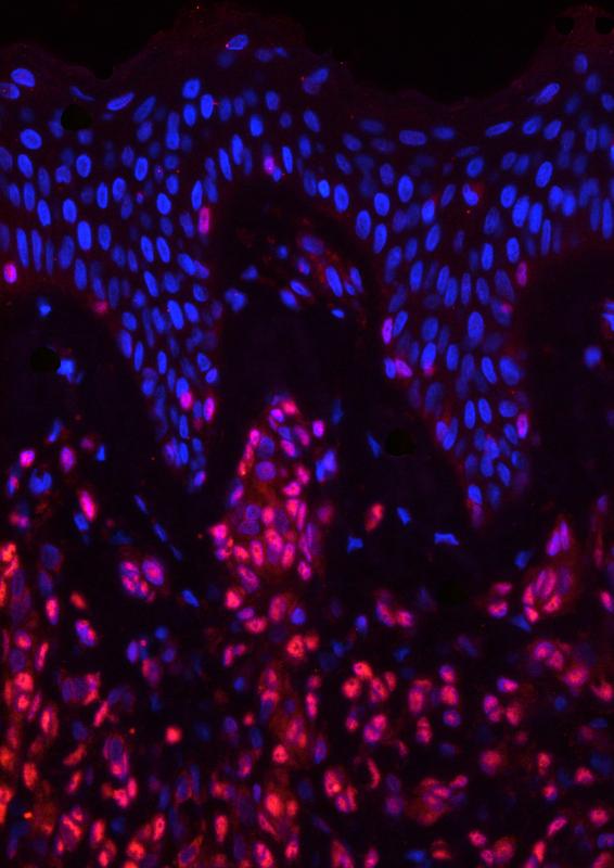 The stem-cell factor Sox10 (red) is active in the tumor tissue of melanoma patients and essential for the development and spread of cancer. 