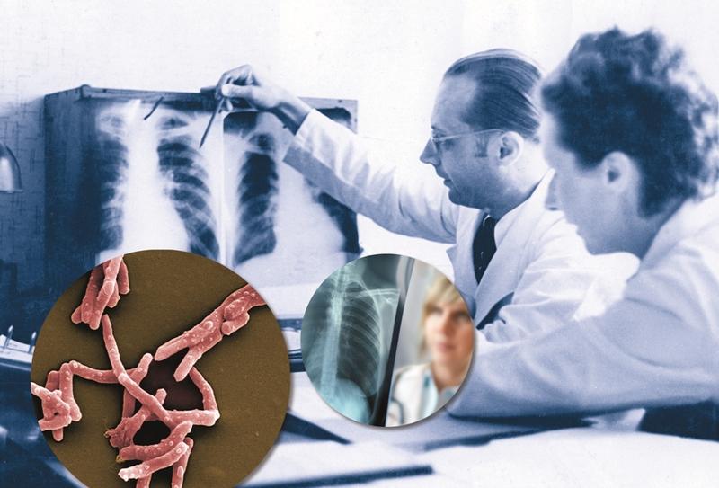 Die Tuberkulose, ausgelöst durch Mycobakterien, befällt in erster Linie die Lunge. Röntgenaufnahmen sind Teil der Diagnostik.
