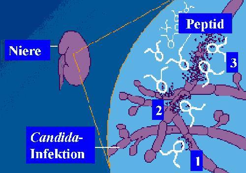 So wirken antimikrobielle Peptide (weiße "Männchen") am Beispiel einer Candida-Infektion der Niere: Zuerst heften sie sich an die Pilze an (1), dann verursachen sie Poren in deren Membranen (2). Am Ende lösen sich die Pilzzellen auf (3).