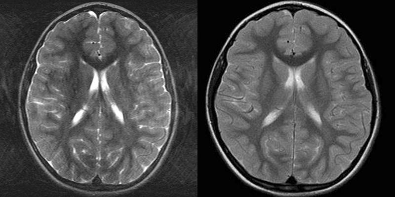 MRT-Bild des Kopfes eines siebenjährigen Patienten: links in konventioneller Technik, auf dem man die Bewegungsartefakte gut erkennt; rechts in BLADE-Technik. Man sieht, dass die Artefakte deutlich reduziert sind und das Bild sehr viel schärfer wirkt