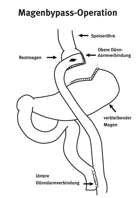 Skizze der Situation nach der Magenbypass-Operation. 