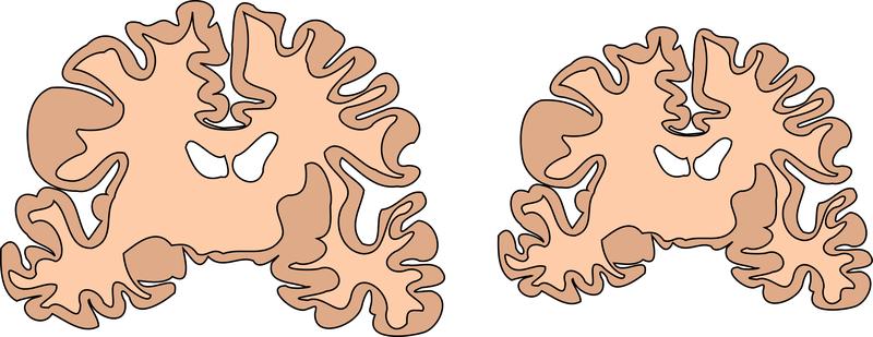Größenvergleich zwischen einem gesunden Gehirn (links) und einem Mikrozephalus. Zeichnung nach einem coronaren Schnitt durch ein menschliches Hirn.