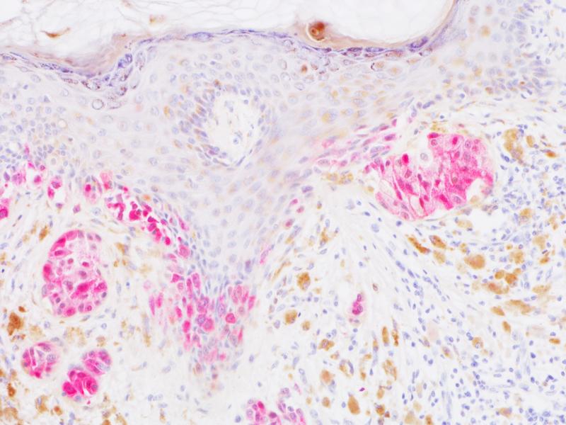 Rot gefärbt sind ehemals bösartige Tumorzellen (Melanomzellen), die im Rahmen der natürlichen Immunkontrolle in den dauerhaften Wachstumsstopp, die Seneszenz (rote Markierung) übergegangen sind. Braun gefärbt sind noch verbleibende Pigment beladene Zellen.