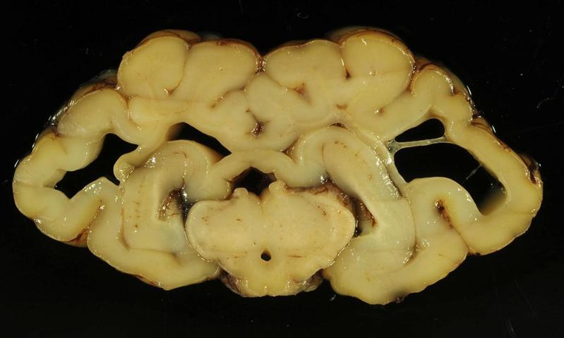 Großhirn eines mit dem Schmallenberg-Virus infizierten Schaflammes. Deutlich zu erkennen sind die Hohlräume in beiden Hemisphären.