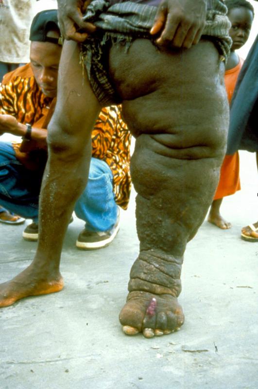 Beim Elefantenmann-Syndrom (Elephantiasis) kommt es durch Lymphstau zu einer abnormen Vergrößerung eines Körperteils. Krankheitserreger sind parasitäre Fadenwürmer, die vor allem durch Stechmücken übertragen werden. 