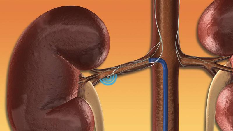 Bei der Renalen Denervation veröden Mediziner über einen Katheter Nervenfasern in den Nierenarterien; diese Nervenfasern sind überaktiv und tragen wesentlich zu einem dauerhaft erhöhten Blutdruck bei. Das schonenden Verfahren wird beim 4. Heidelberger Angiologietag am Samstag, den 9. März 2013, vorgestellt. 