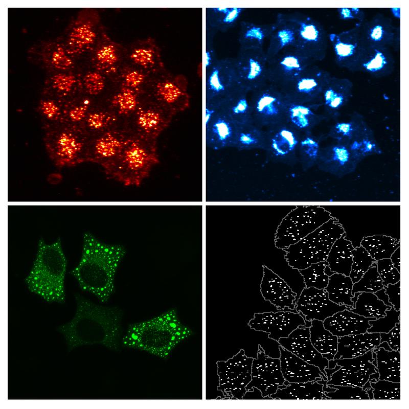 Hochauflösende Fluoreszenz-Mikroskopie zur Identifizierung neuer Cholesterin-regulierender Gene: Oben links: Cholesterinaufnahme (orange) in die Zellen; oben rechts: freies Cholesterin (blau) in den Zellen; unten links: Lokalisation eines neuen Cholesterin-regulierenden Proteins (grün); unten rechts: Zellmasse (grau), aufgenommene Cholesterin-Partikel (weiß). 