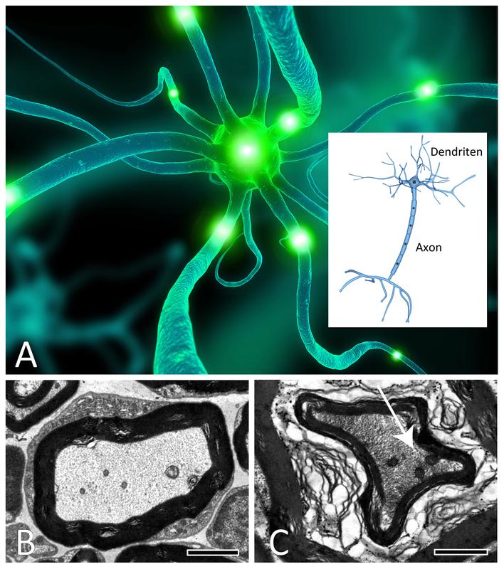 Nervenzellen (Neuronen) sind hoch spezialisierte, sehr sensible Zellen, die für die Weiterleitung von Informationen entlang der Kommunikationswege des Nervensystems zuständig sind (A). Sie bestehen aus einem Zellkörper mit verschiedenen Fortsätzen: mehreren kurzen Dendriten, die elektrische Signale von Nachbarzellen aufnehmen und einem, meist langen, Axon, das die Impulse an andere Zellen weiterleitet. Die elektronenmikroskopische Aufnahme (B) zeigt den Querschnitt eines normalen Axons. Durch den Verlust des Proteins Merlin, dessen Mutation zu NF2 führt, kollabiert der Nervenfortsatz und ist nicht mehr funktionstüchtig (C).
