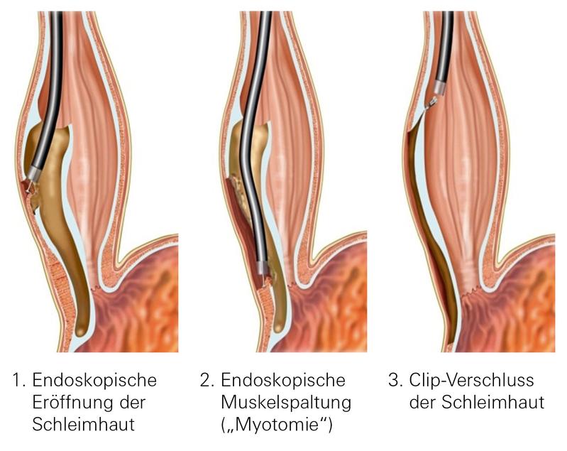 Bei der peroralen endoskopischen Myotomie wird auf dem Wege der Spiegelung (Endoskopie) zunächst die Schleimhaut eröffnet und ein Tunnel gebildet (1), dann der Muskel gespalten (2) und schließlich der Clipverschluss der Schleimhaut (3) durchgeführt. 