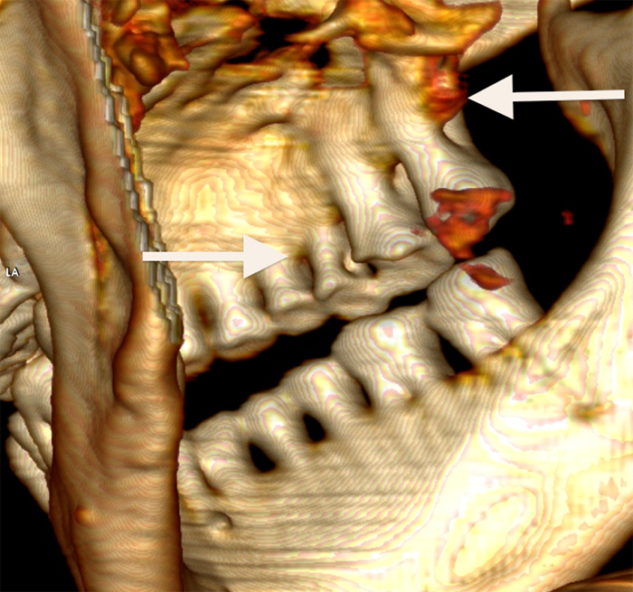 Blick auf die rechte Seite der Zahnreihen (3D-Rekonstruktion). Pfeil nach rechts: tiefe kariöse Läsionen, Pfeil nach links: starker Knochenschwund der Backenzähne