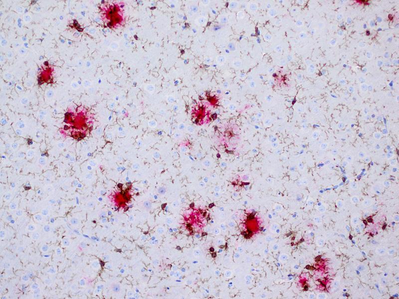 Immunzellen des Gehirns, die Mikroglia (braun), scharen sich um Amyloid-beta- Ablagerungen (rot) in einem Alzheimer-Mausmodell. 