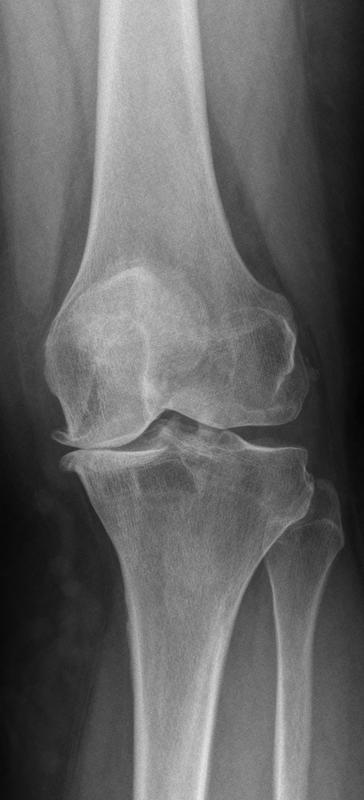 Röntgenbild einer fortgeschrittenen Arthrose des Kniegelenks.