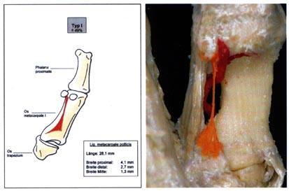 Ligamentum metacarpale pollicis heißt das neu entdeckte Band (orange). Es fixiert eine Daumen-Arterie (rot) und kann sie dabei einschnüren. Das Bild in hoher Auflösung finden Sie unter http://www.verwaltung.uni-bonn.de/presse/pm/Daumenband.JPG.