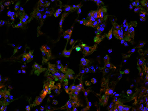 Lungenzellen infiziert mit dem Influenzavirus (grün gefärbt) und Legionella (rot gefärbt). Der Zellkern ist blau gefärbt.