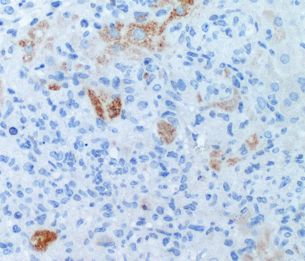 Leberzellen unter dem Mikroskop. Apoptotische Zellen sind braun gefärbt, Zellkerne blau.