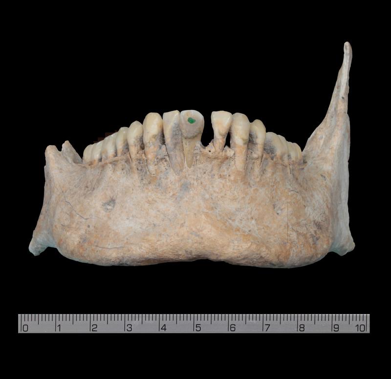 Zeichen herausragender sozialer Stellung: Wissenschaftler der Universität Bonn entdeckten an einigen Schädeln aus dem Massengrab in der früheren Maya-Stadt Uxul (Mexiko) Einlagen aus Jade an den Schneidezähnen. Sie waren ein beliebter Körperschmuck bei den vorspanischen Maya, der aufgrund der Seltenheit des Rohstoffs sozial hochgestellten Personen vorbehalten war. Mit Steinwerkzeugen wurden kleine Aushöhlungen in den Zahn gebohrt und mit einem Stück Jade passgenau ausgefüllt. 