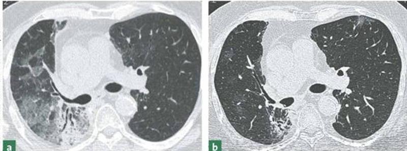 Abb. a: Symptomatische Pneumonitis vier Wochen nach Strahlentherapie eines Lungenkarzinoms mit 60 Gy. Abb. b: Fibrotische Residuen sechs Monate nach Strahlentherapie.