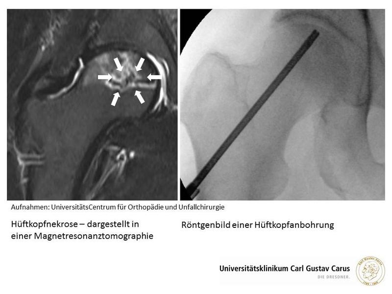 Hüftkopfnekrose – dargestellt in einer Magnetresonanztomographie und Röntgenbild einer Hüftkopfanbohrung.