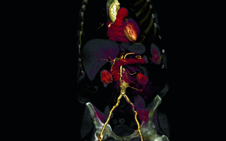CT Angiografie einer Patientin mit schlechter Nierenfunktion. Die Untersuchungszeit betrug nur 1 Sekunde. Die Kontrastmittelmenge konnte von 150 ml auf nur 40 ml reduziert werden.