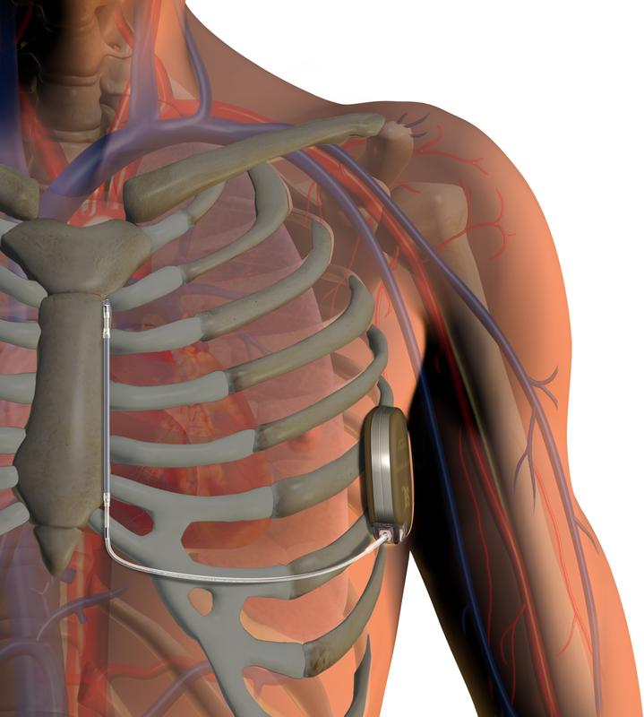 Der S-ICD wird in der seitlichen Region des Brustkorbes unter dem linken Arm direkt unter der Haut platziert. Eine elektrische Leitung, die zum Brustbein läuft, wird ebenfalls unter die Haut gelegt. 