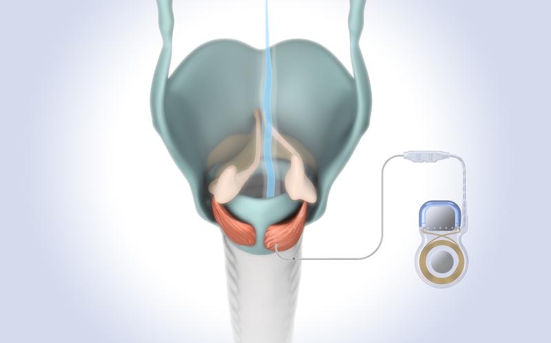 Durch den Impuls des Implantats wird einer der Öffnermuskeln aktiviert, eines der beiden Stimmbänder gleitet zu Seite und der Atemstrom (blaue Linie) kann passieren.