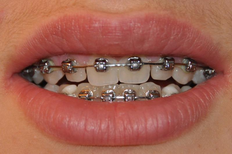 Ein 15-jähriges Mädchen mit Multiband-Multibracket-Apparaturen.