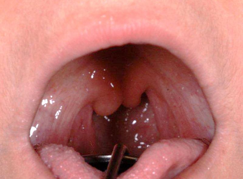 Als Uvula bifida - hier bei einer Patientin - bezeichnen Mediziner die Längsspaltung des Gaumenzäpfchens. Sie kann ein Hinweis auf einem PGM1-Mangel sein