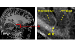 Die Grenze zwischen den wichtigen Gehirnstrukturen Hippocampus und Amygdala ist in hochaufgelösten Kernspintomografie-Bildern als feiner heller Streifen erkennbar.