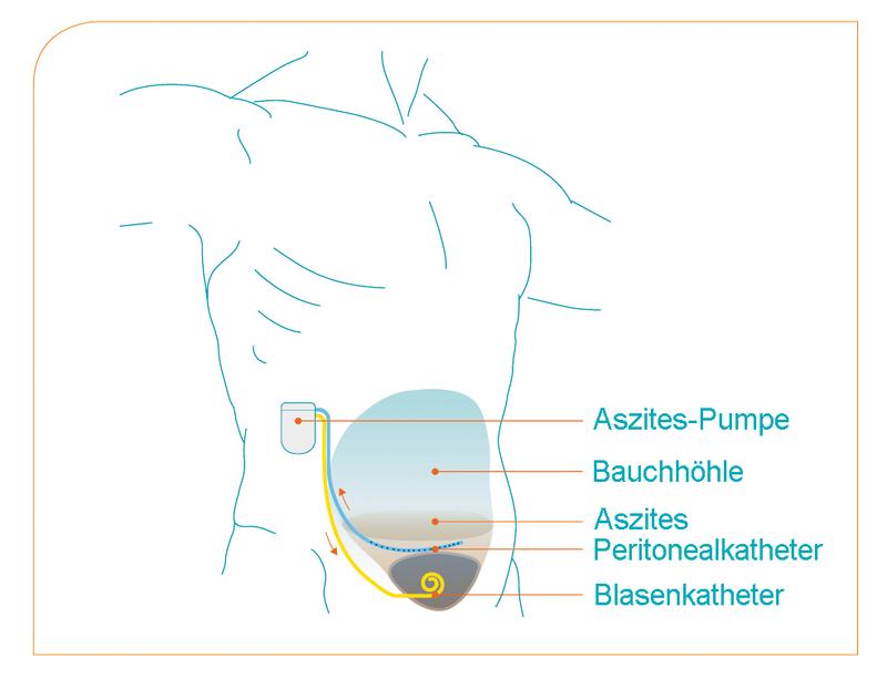 Die Aszites-Pumpe saugt die freie Flüssigkeit aus der Bauchhöhle ab und pumpt sie in die Harnblase des Patienten.