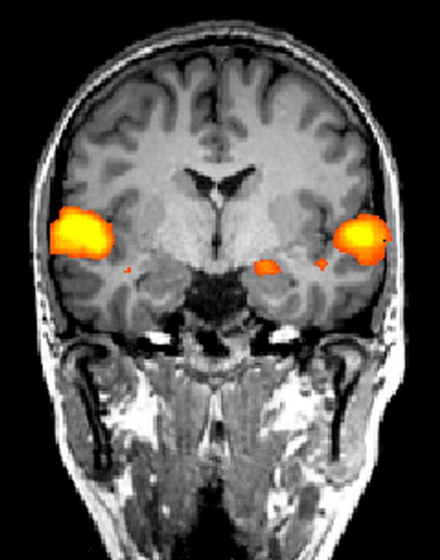 Am Würzburger Zentrum für Psychische Gesundheit wird zum Beispiel untersucht, in welchem Umfang Gehirnbereiche wie Inselregion und Mandelkern beim Auftreten von Furcht und Angst aktiviert werden.
