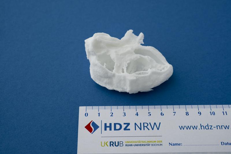 3-D-Modell des Mumienherzens in Originalgröße: Die kleine linke Herzkammer ist gut zu erkennen. Diagnose: Hypoplastisches Linksherzsyndrom (HLHS)